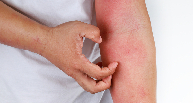 紫外線アレルギー 日焼け止めを塗ったら湿疹ができた その原因とは キラ リズム